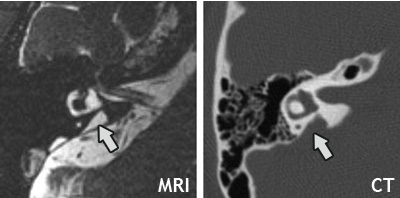 Hình ảnh giãn rộng cống tiền đình EVA trên CT và MRI tai trong - khoyte.com - Bs. Nguyễn Thị Ngọc Minh