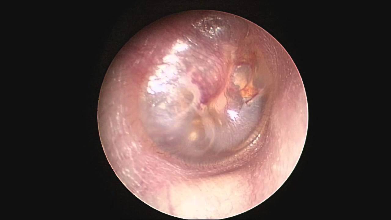 Chấn thương khí áp có dịch trong tai giữa - Dr.Minh - khoyte.com