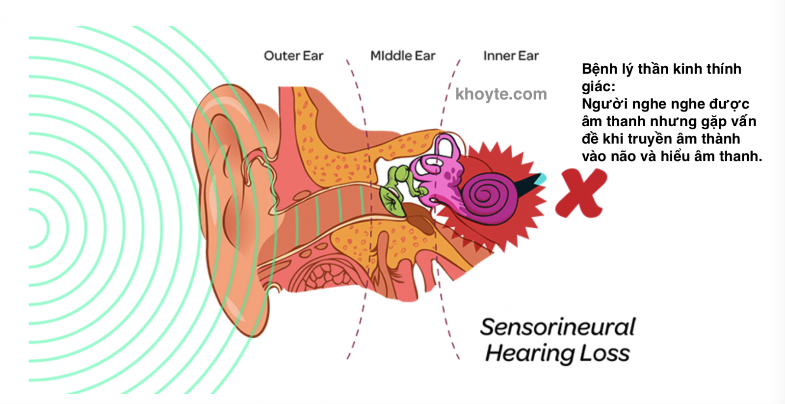 Bệnh lý thần kinh thính giác - Auditory Neurophathy
